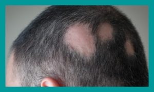 Hair Loss Treatment