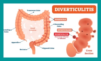 Diverticulitis treatment