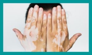 vitiligo treatment