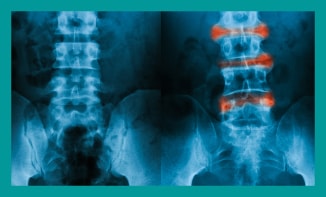 Treatment for ankylosing spondylitis