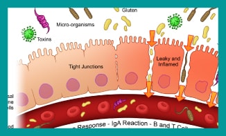 treatment for leaky gut