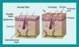 psoriasis treatment