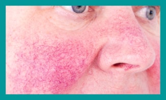 rosacea treatment