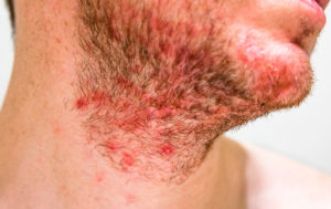 seborrheic dermatitis treatment